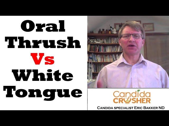 What Is The Difference Between A White Tongue And Oral Thrush?  Ask Eric Bakker