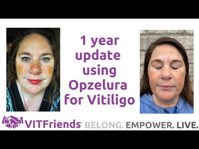 1 year using Opzelura for Vitiligo and a new development!