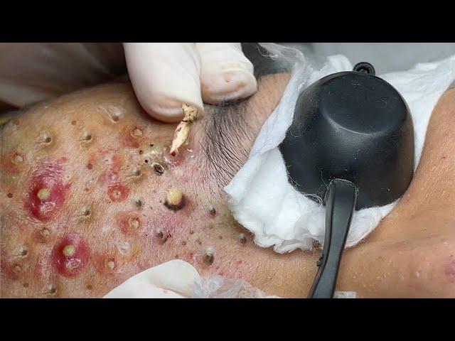 Loan Nguyen Acne Treatment 91e