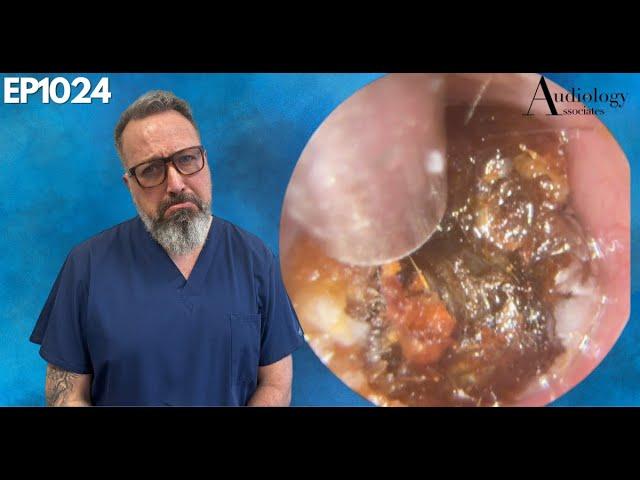 Irritated Ear Canal Wax Removal - EP1024