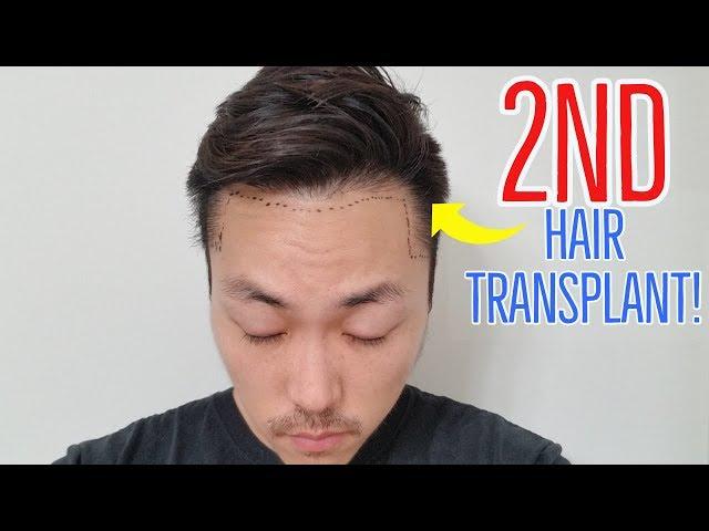 IM GETTING A 2ND HAIR TRANSPLANT IN 2019!