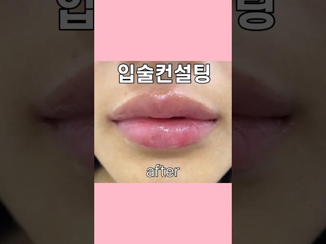 인중 짧아지는 러시안립필러 #입술컨설팅