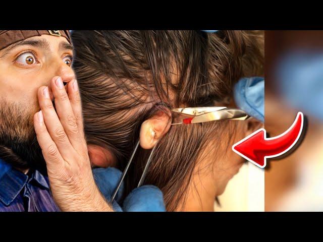 Popping huge blackheads and Giant Pimples- Best Pimple Popping Videos