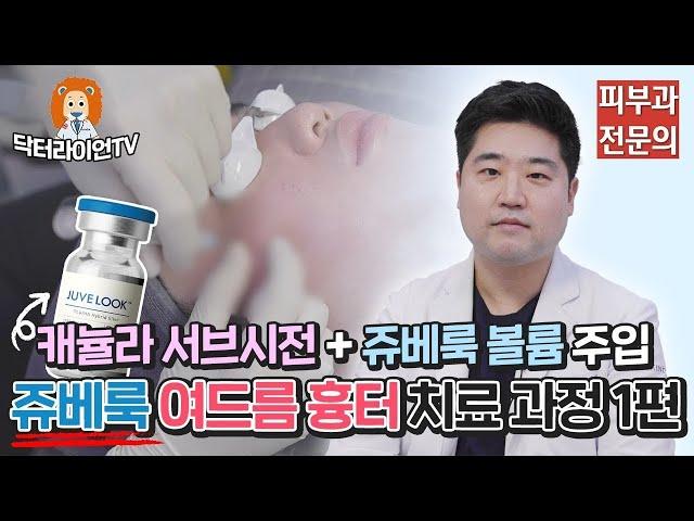 닥터라이언이 직접 보여주는 쥬베룩 여드름 흉터 치료 과정 1편 (캐뉼라 서브시전 + 쥬베룩 볼륨 주입)