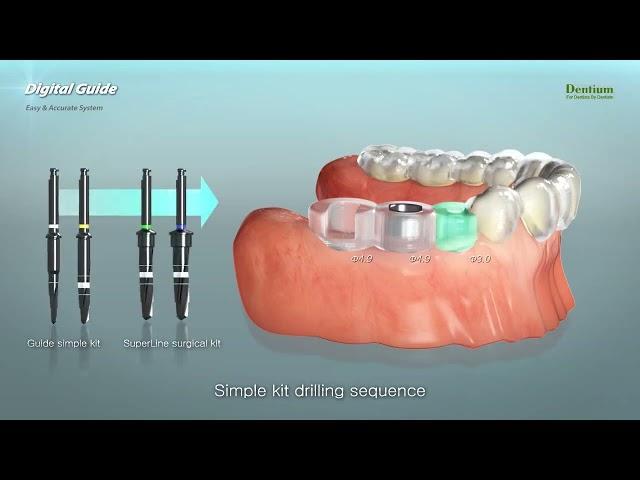 Dentium Digital Guide