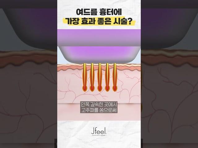 여드름 흉터 치료에 가장 좋은 시술! 직접 피부에 구멍을 뚫는다고? 