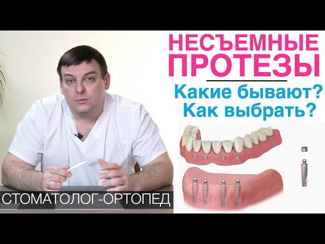 Несъемные зубные протезы: какие бывают и как выбрать несъемный протез для зубов? Зубные мосты и др.