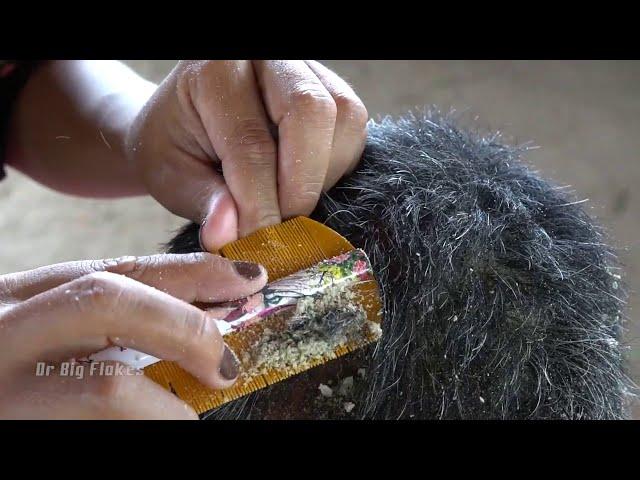 Wow Big Flakes In My Daddy's Hair !! Natural Dandruff Scratching Scalp #180