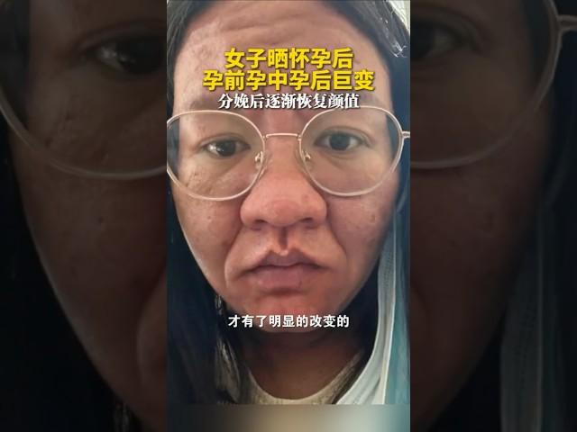 云南女子晒怀孕后孕前孕中孕后巨变，分娩后逐渐恢复颜值 #怀孕