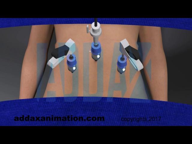 laproscopy procedure animation