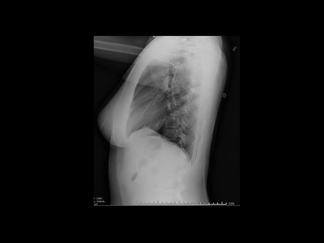 Introduction to Chest Radiography