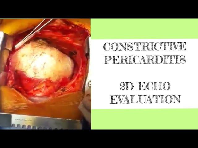 Constrictive pericarditis - 2D ECHO evaluation