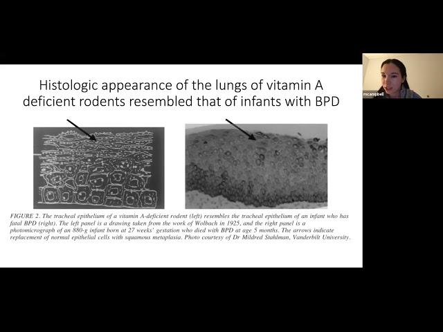 52in52 Journal Club - Vitamin A BPD 3-25-21