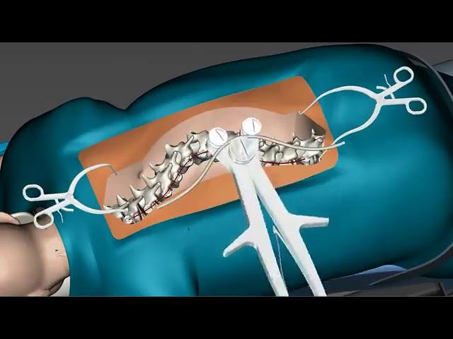 Spinal Curvature Surgery 3D