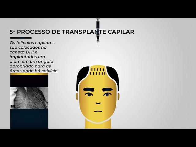 Transplante Capilar DHI