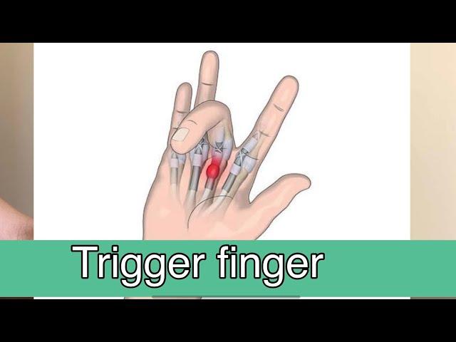 Trigger finger Exercise | House Physiotherapy