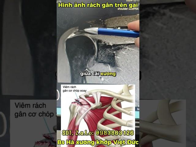 NHẬN BIẾT RÁCH GÂN TRÊN GAI TRÊN PHIM CỘNG HƯỞNG TỪ
