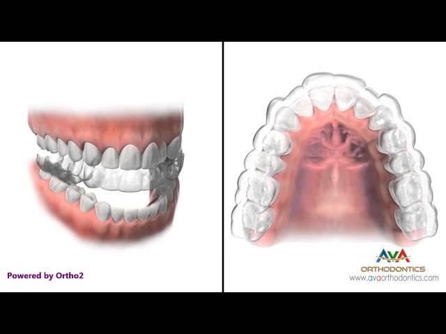 How Invisalign or Clear Aligners work - Orthodontic Treatment