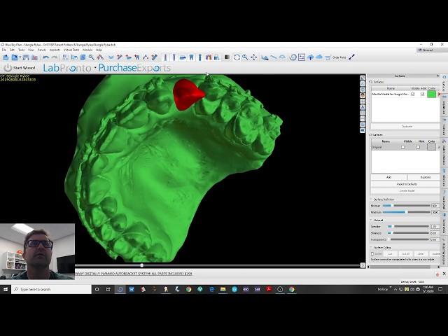 Blue Sky Bio - Single Implant Surgical Guide Design