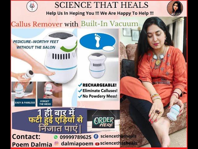 Callus Removal with built-in vacuum | dead skin removal | hindi | DIY | Daily remedy