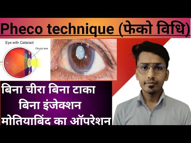 Phaco technique/ cataract surgery use by pheco technique/फेको विधि /मोतियाबिंद/मोतियाबिंद का ऑपरेशन