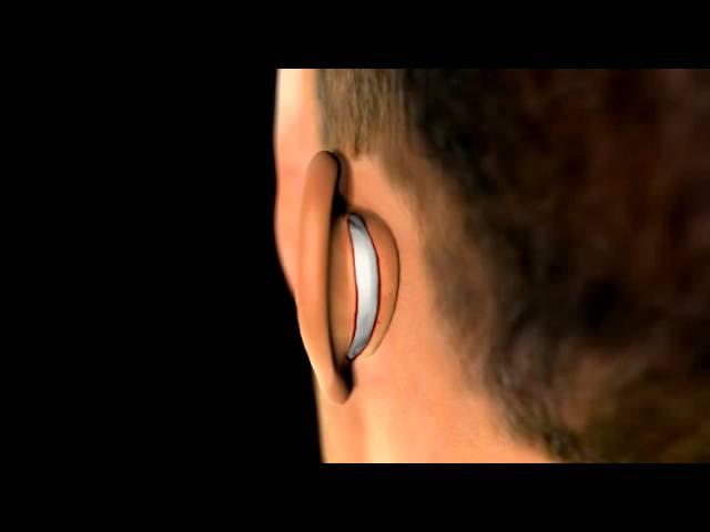 Ear Plastic Surgery - 3D Medical Animation || ABP ©