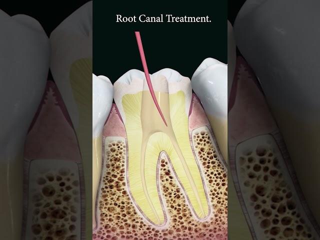 Root canal treatment