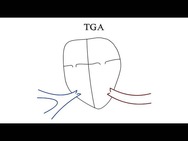 Transposition of the Great Arteries (TGA)