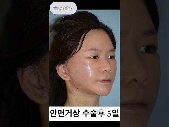 30대 여자, 턱광대 수술 후 피부처짐으로 너무 나이들어 보여 걱정했는데ㅠㅠ 다시 20대로 돌아왔어요!!