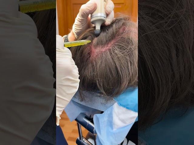 PRP Injections for Hair Growth
