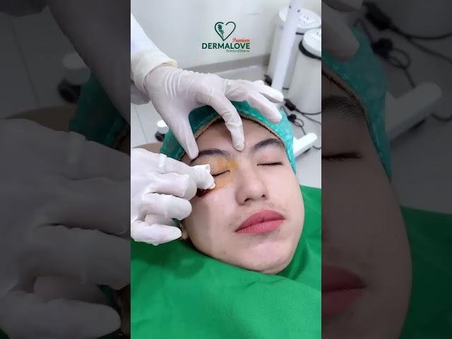 “Derma Non-Surgical Double Eyelid” now available at Premium Dermalove Batam 