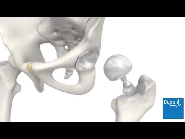 How a hip replacement is carried out | Bupa Health