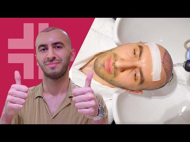 Dhi Hair Transplant - Full Journey