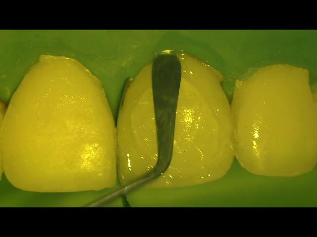 Композитная реставрация шести передних зубов. Direct composite restoration of the front teeth