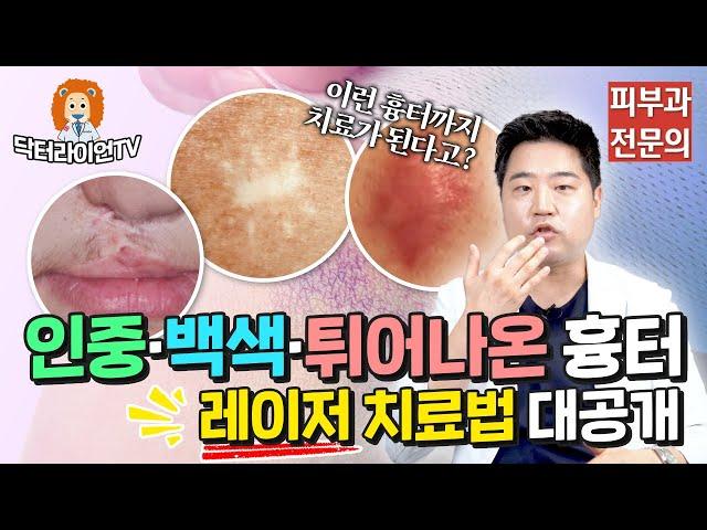 [수술외상흉터 정복 6탄] 이런 흉터까지 치료가 된다고? 인중 흉터/흰색 흉터/백색 흉터/튀어나온 흉터 레이저 치료 방법 대공개!