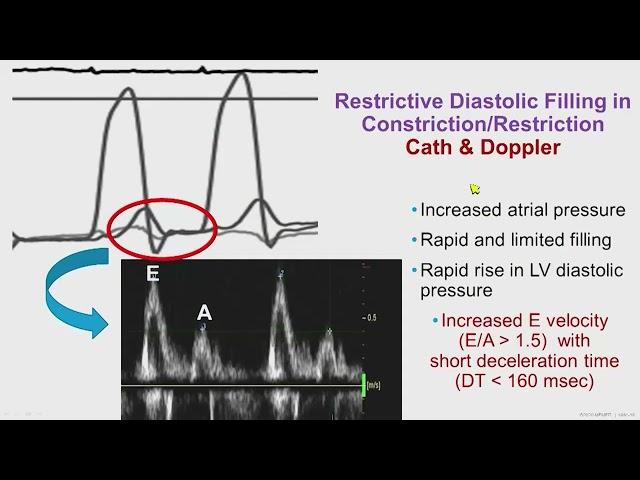 Constrictive Pericarditis