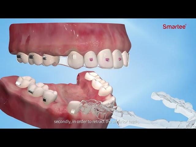 Smartee S12  ( GS attachments & Fixed segment appliance)