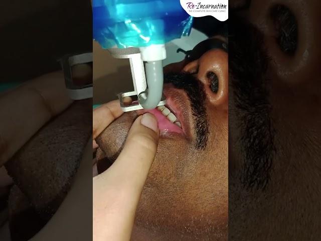 Fractional CO2 Laser for Vitiligo | Dr. Priyanka Agarwal