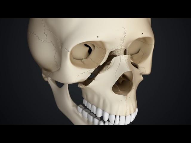 LeFort I, II and III type fractures — animation shorts for Monash University, Australia