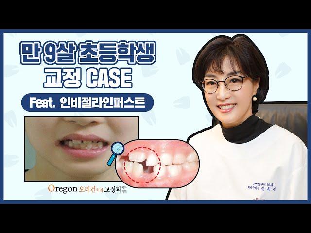 【만 9살 초등학생 - 남자 어린이 투명교정】 인비절라인 퍼스트로 치아교정 치료 받기 참 좋은 나이에요^^