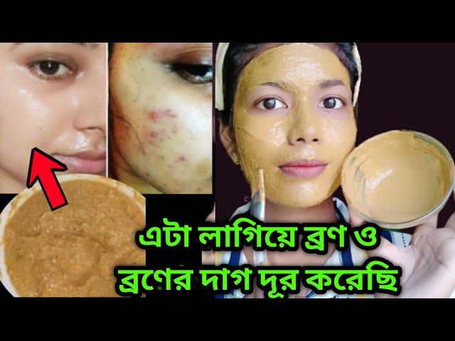 ব্রণ থেকে মুক্তি পাবে 1 দিনে 100 % গ্যারান্টি || bron dur korar upay || How To Remove Acne Pimple