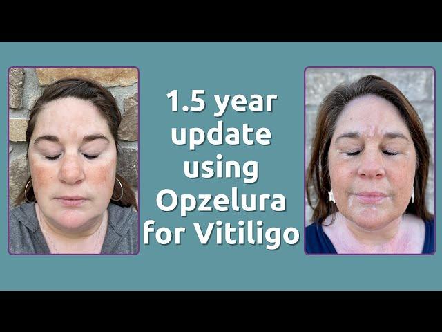 1.5 year update using Opzelura for Vitiligo & Phototherapy