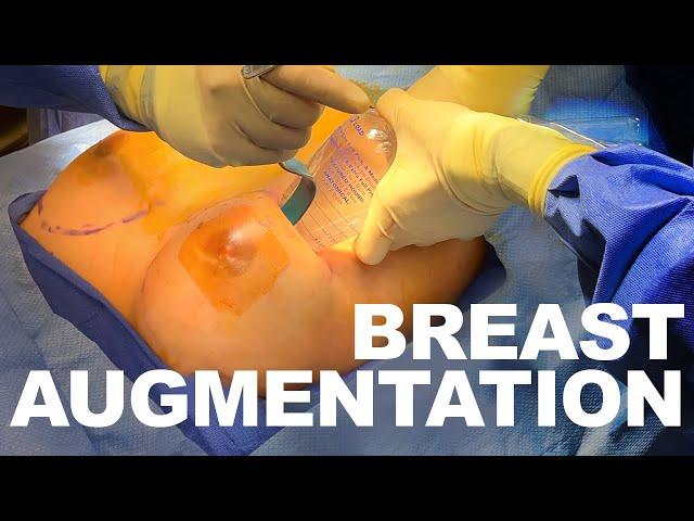 Breast Augmentation with Silicone Implants - Dr. Paul Ruff | West End Plastic Surgery