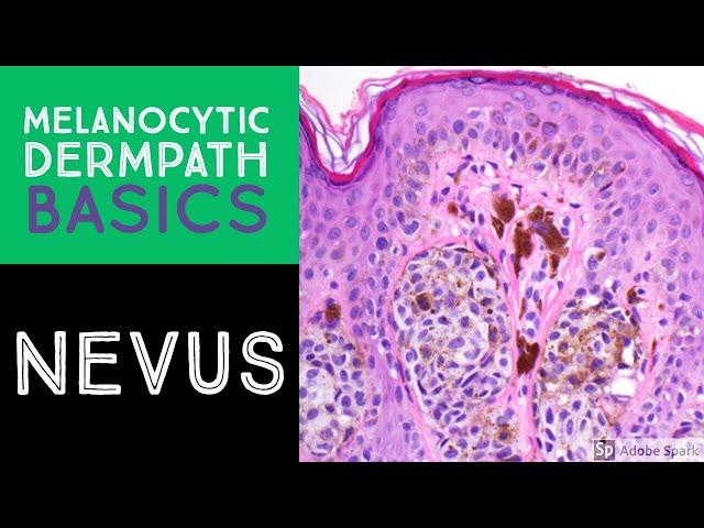 Melanocytic Dermpath Basics: Benign Nevus