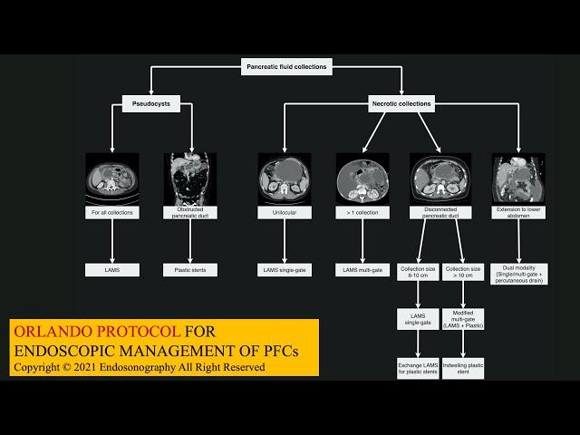 EUS Masterclass - Orlando protocol for Endoscopic Management of Pancreatic Fluid Collections