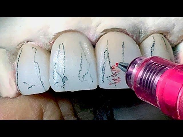 Tooth Morphology Design Techniques for Dental Lab Technicians