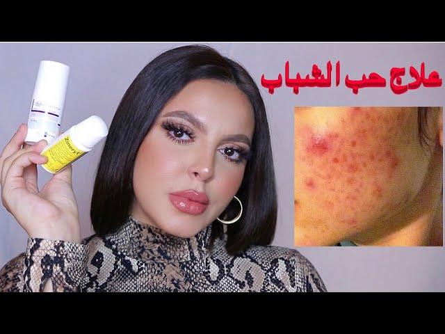 إزاي عالجت وشي من حب الشباب و نصايح للتخلص من آثار الحبوب محدش بيتكلم عنها | How I cleared my Acne