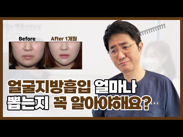 얼굴지방흡입 할 때 지방을 얼마나 빼냐구요?