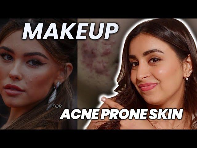 Flawless & Acne-Free: Dr. Riya's Ultimate Makeup Guide for Acne Prone Skin !