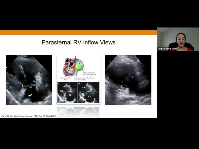 Joint Echo Conference: Structural Heart TV Intervention